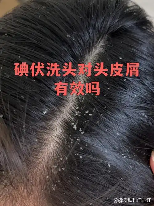 SEO是洗发水还是去屑剂？如何判断头皮烦恼属于哪类？