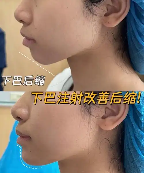 seo玻尿酸怎么样？玻尿酸注射效果真的那么好吗？