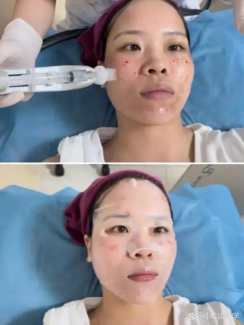 SEO基础水光后修复