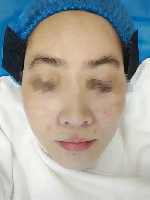 SEO基础水光后修复